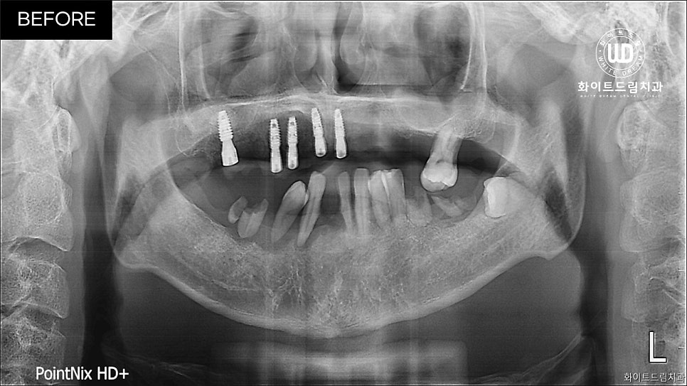 전체임플란트 식립 및 임플란트뼈이식 후기 관련 이미지 4