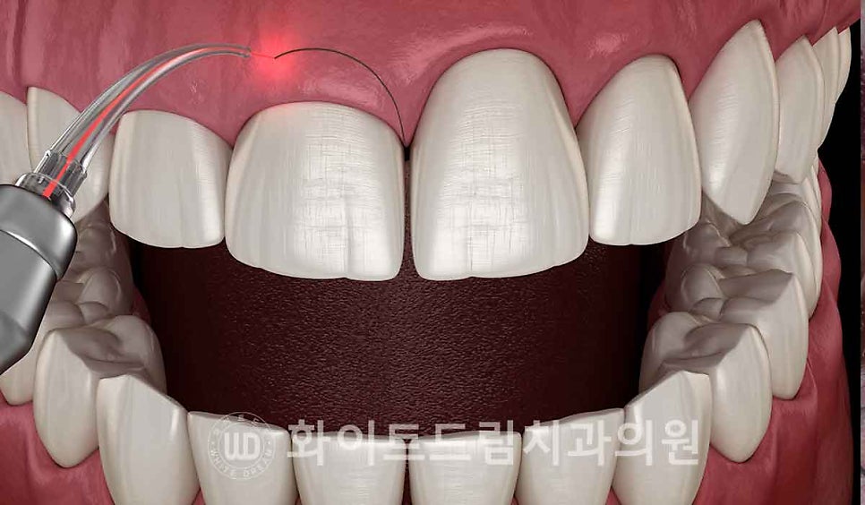 강남옹니라미네이트 "치아가 안으로 들어가서 할머니처럼 보여요" 경미 & 중증도 옹니 라미네이트 치료 관련 이미지 12