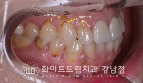 치경부착색 치료 / 라미네이트 vs 올세라믹 치아 삭제량 비교 (Feat. 라미네이트 후 치아미백 가능한가요?) 관련 이미지 4