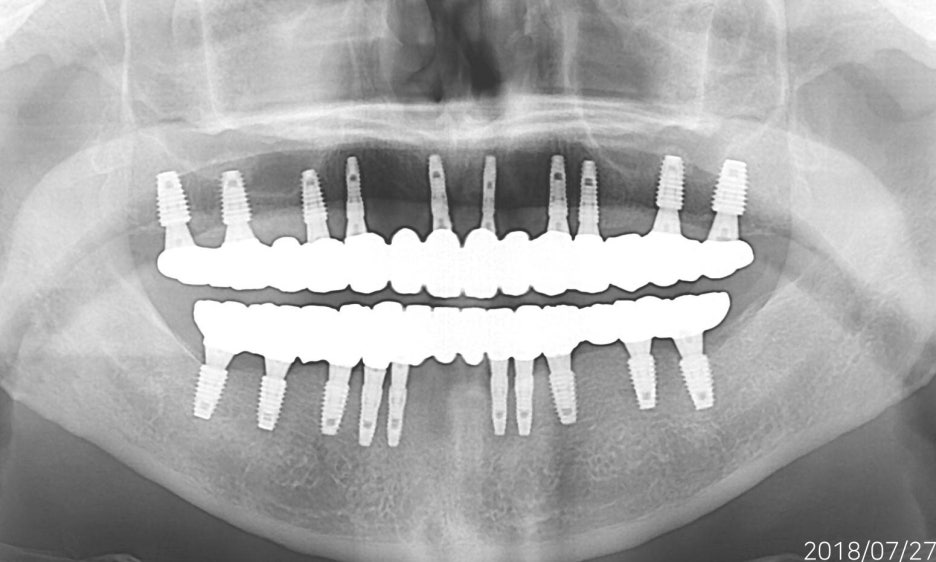 임플란트 하기 전 알아보아야 할 것. 관련 이미지 17