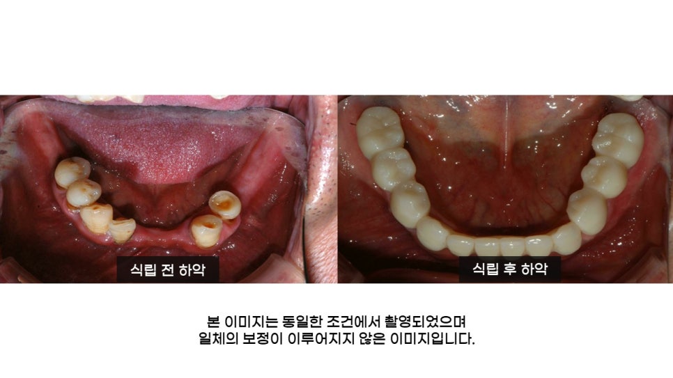 어금니임플란트 수복 및 당뇨환자임플란트 가격, 종류, 통증 관련 이미지 22