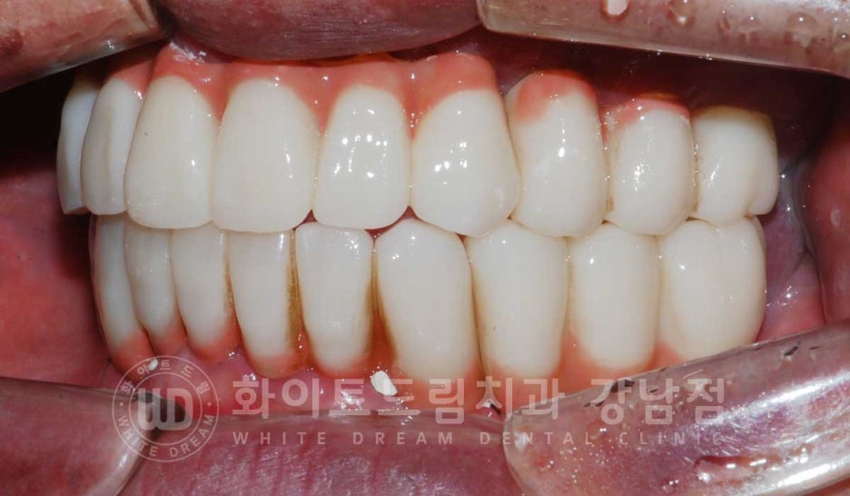 Gangnam Station Dental Clinic Specializing in Implant Revision Surgery—Revision Surgery and Full-Mouth Implant Treatment at the Same Time! image 10