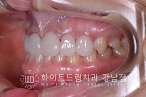 벌어진 앞니라미네이트 / "왜소치로 치아가 벌어졌어요" 치료 사례 관련 이미지 11