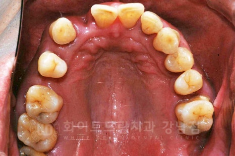 상악동거상술 잘하는치과, 강남역 화이트드림치과 상악동 함기화로 인한 거상술 치료 리뷰 관련 이미지 10