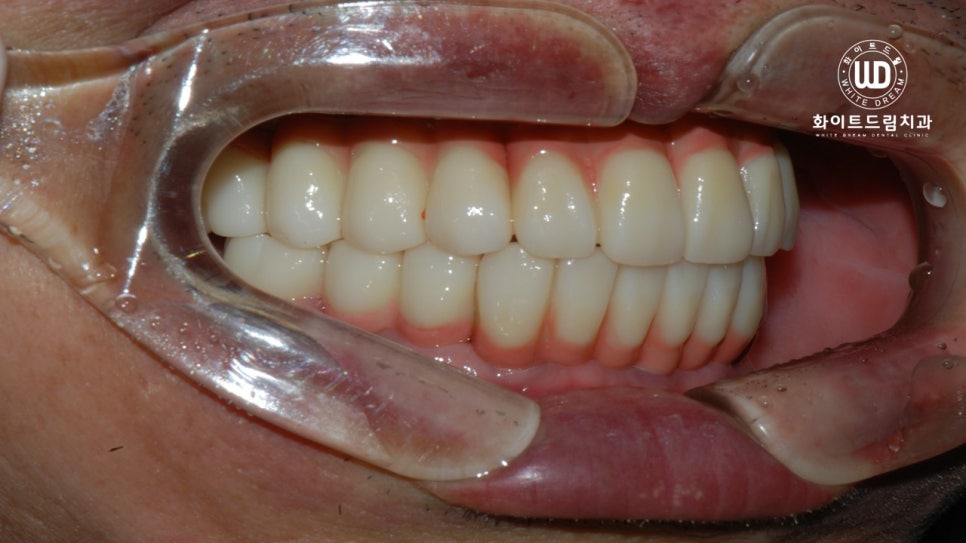 무너진 잇몸뼈와 치아 상실을 대체하는 전악임플란트 치료 사례 관련 이미지 10