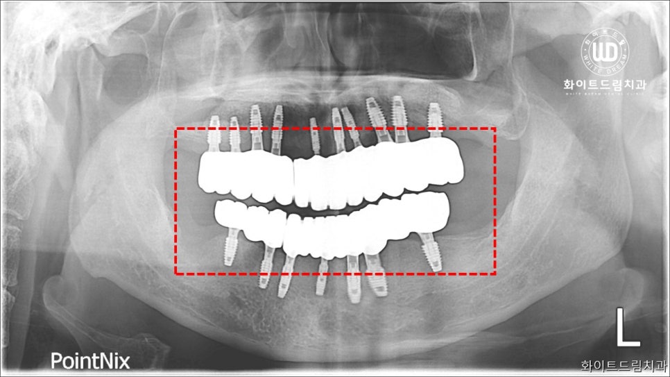 무너진 잇몸뼈와 치아 상실을 대체하는 전악임플란트 치료 사례 관련 이미지 9