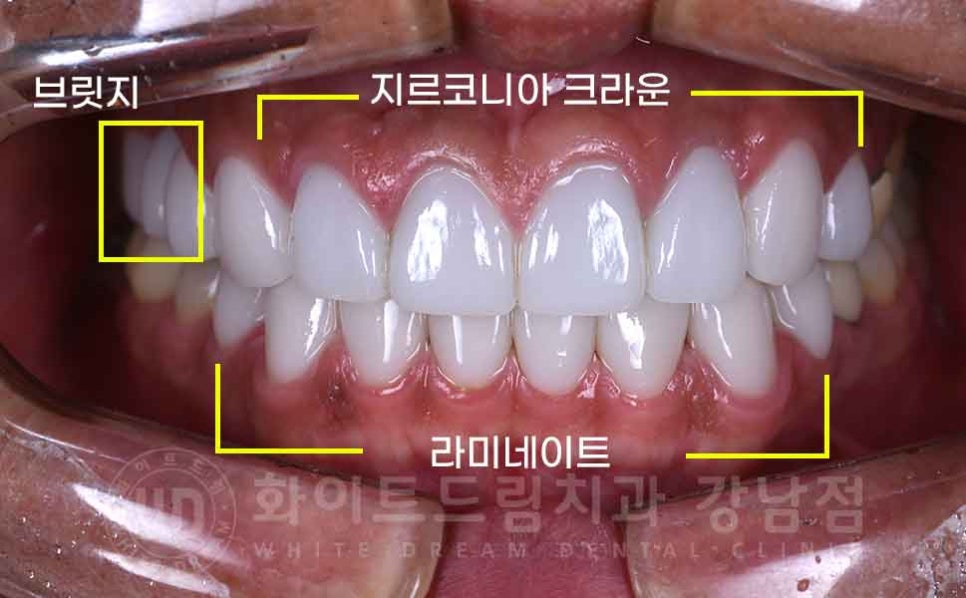 역삼역 앞니 치료  "예전에 한 크라운, 라미네이트 바꾸고 싶어요" 라미네이트 & 크라운 재치료 관련 이미지 8
