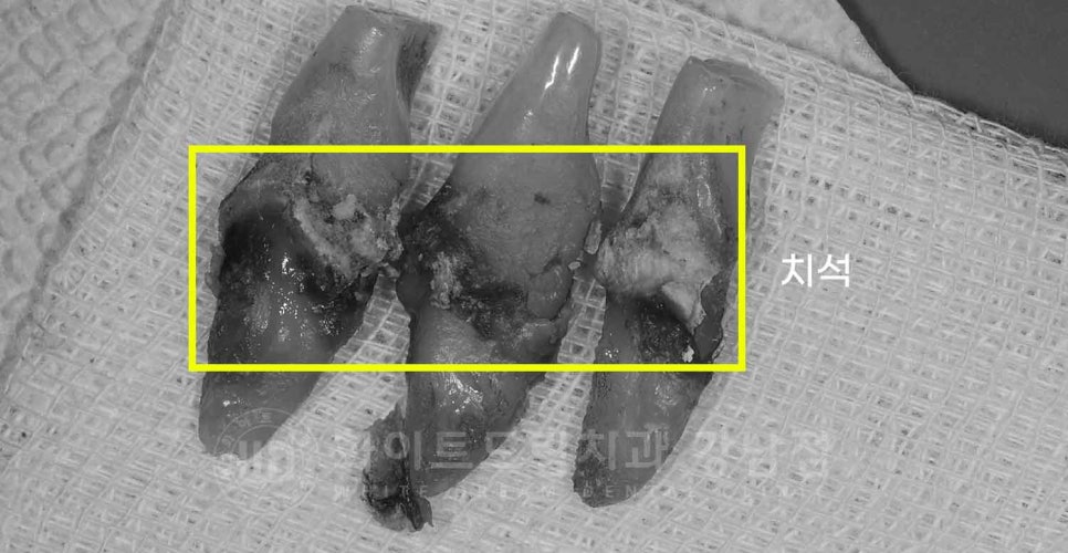 강남역 전악 임플란트 "치아가 흔들리고 빠져요!" 치주염 임플란트 치료 관련 이미지 4