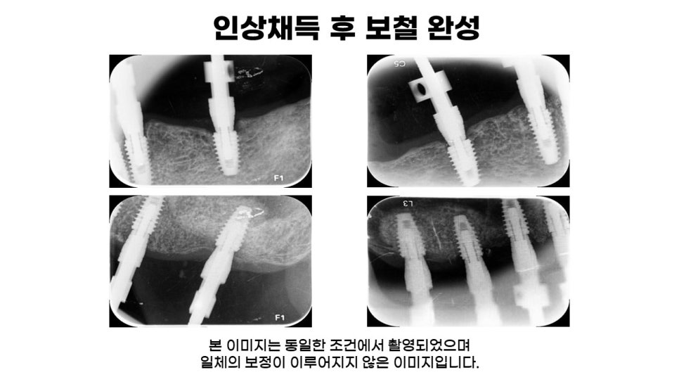 어금니임플란트 수복 및 당뇨환자임플란트 가격, 종류, 통증 관련 이미지 11