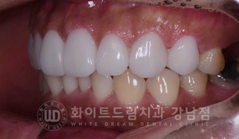 틀어진 치아 라미네이트, 틀어지고 색이 다른 앞니가 고민이에요. 관련 이미지 13