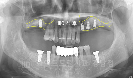 서초동 치과 추천 / "임플란트 개수를 줄이는 식립 방법은?" 강남 화이트드림치과 임플란트 관련 이미지 12