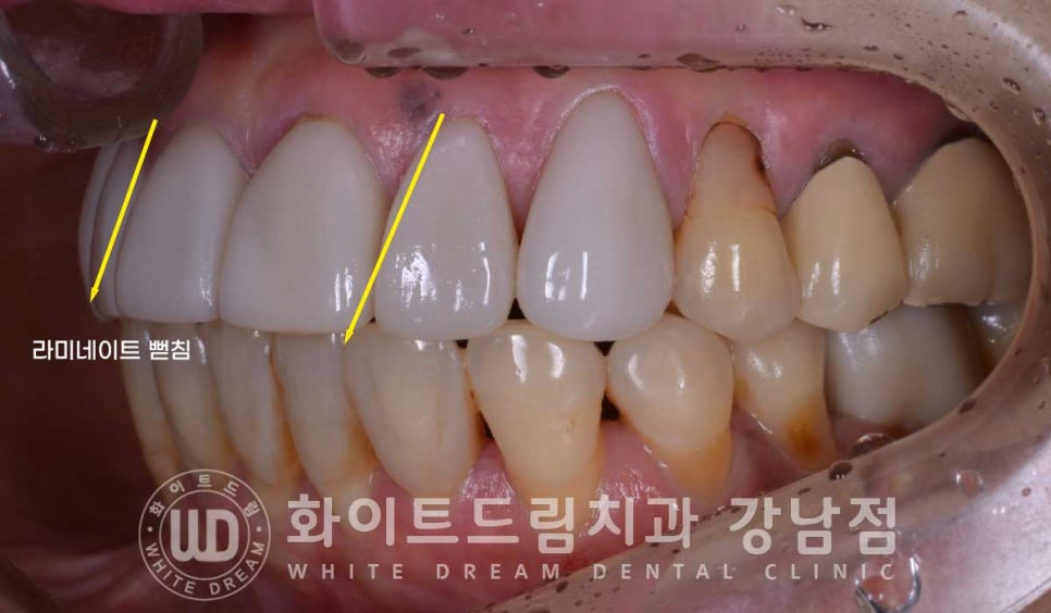 앞니라미네이트 교체 "5년 전에 한 라미네이트가 뻗쳐 보여요" 예쁘게 치료할 수 있나요? 관련 이미지 1