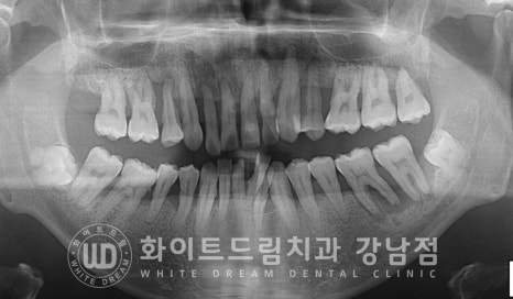 40대 전체임플란트 / 디지털스캔바디를 이용한 전체 임플란트 치료 사례 (Feat. 치주염) 관련 이미지 3