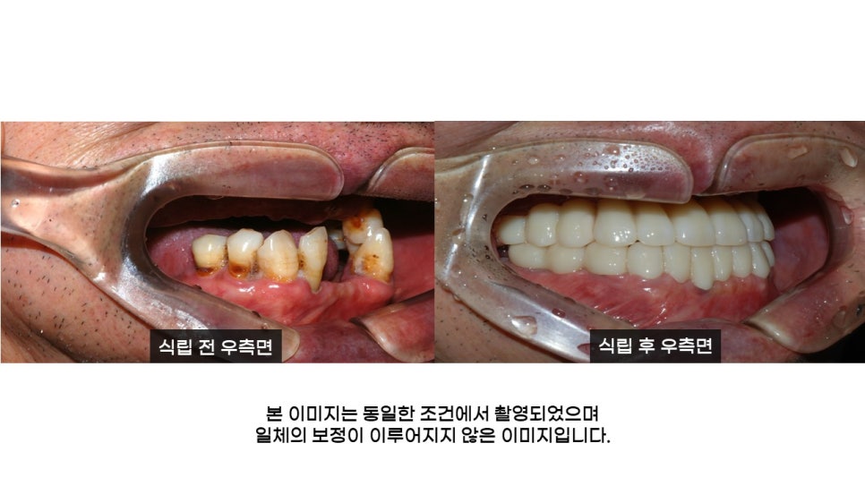 어금니임플란트 수복 및 당뇨환자임플란트 가격, 종류, 통증 관련 이미지 19