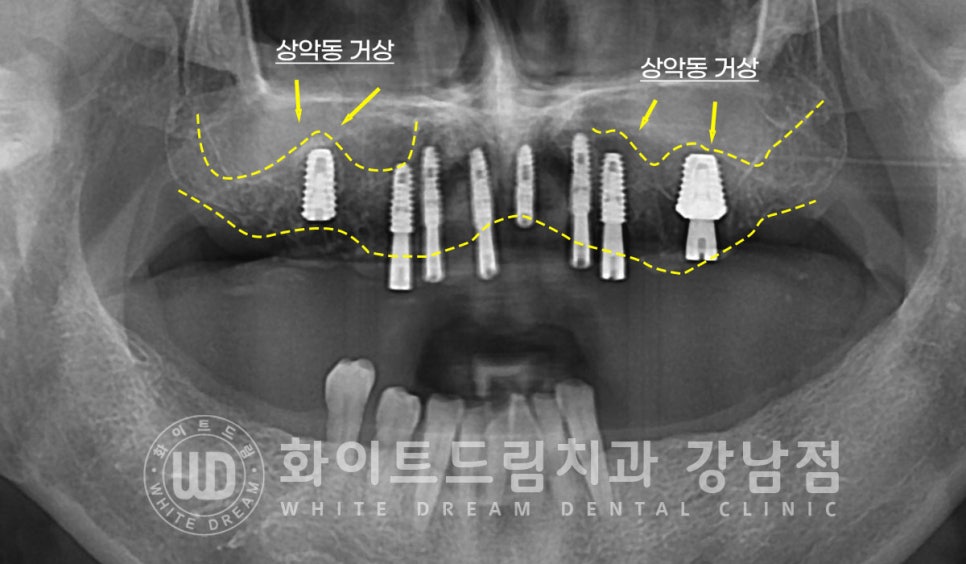 상악 풀케이스임플란트 사례 / "지인 추천으로 인천에서 왔어요." 관련 이미지 9