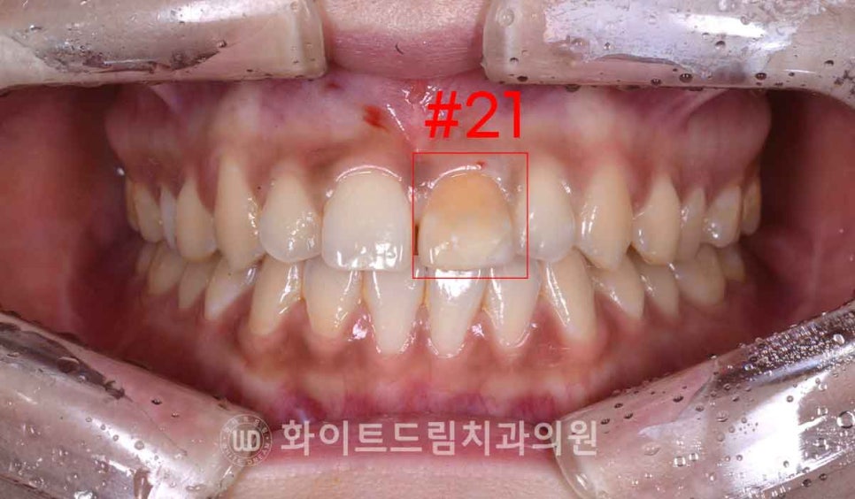 강남역앞니치과 / "신경치료한 치아가 누렇게 변했어요." 신경치료 후 변색된 치아, 어떻게 치료하나요? 관련 이미지 5