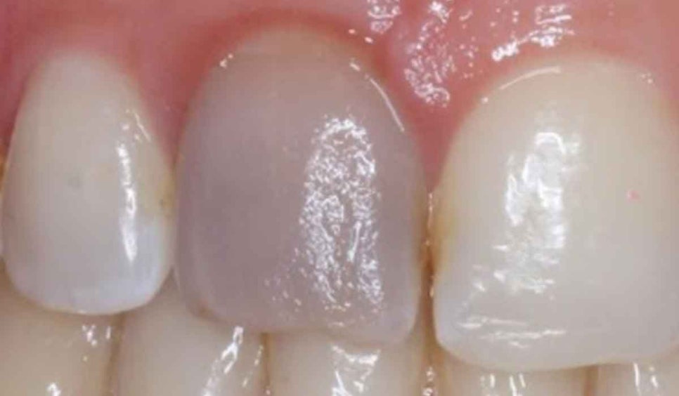 강남역앞니치과 / "신경치료한 치아가 누렇게 변했어요." 신경치료 후 변색된 치아, 어떻게 치료하나요? 관련 이미지 8