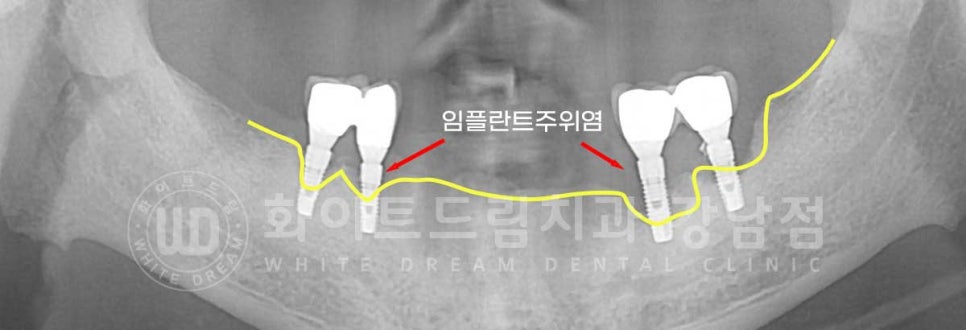 임플란트 재수술 잘하는치과 / 재수술과 전체 임플란트 치료를 동시에! 관련 이미지 6