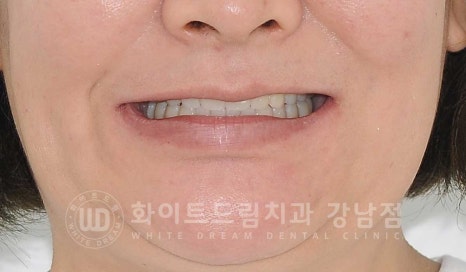 치주염 전체임플란트 치료 사례 / 치아를 흔들리게 만드는 치주염이란? 관련 이미지 4