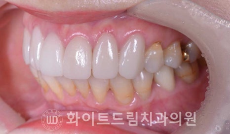 신논현라미네이트, 중년 충치치료, "치경부 우식증, 라미네이트로 당일 치료 OK" 관련 이미지 12