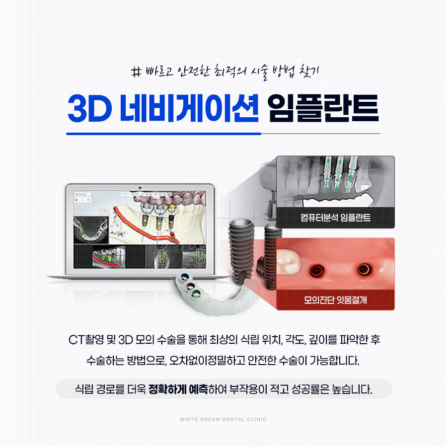 임플란트 하기 전 알아보아야 할 것. 관련 이미지 8