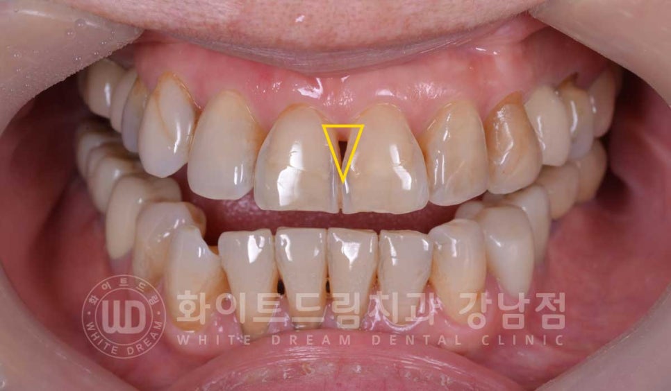노화된 치아 라미네이트 / 치아미백을 해도 하얘지지 않는 마모된 치아는 어떻게 할까? 관련 이미지 9