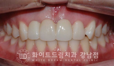 앞니 빠짐 임플란트 / 사고로 인한 앞니 탈구. 앞니 임플란트 치료는? 관련 이미지 18