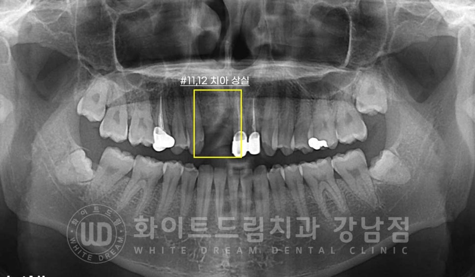 앞니 임플란트 사례 "예전에 심은 임플란트를 뺐어요. 재수술 가능할까요?" 관련 이미지 4