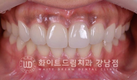 신경치료 후 변색된치아, 라미네이트로 변색과 모양까지 개선! / 강남역화이트드림치과 관련 이미지 11