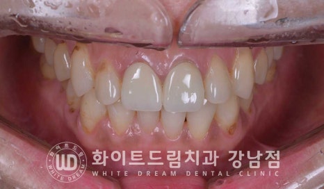치경부착색 치료 / 라미네이트 vs 올세라믹 치아 삭제량 비교 (Feat. 라미네이트 후 치아미백 가능한가요?) 관련 이미지 1