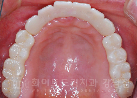 서울 전체임플란트 기간 / 전체 임플란트 7개월 완성, 무치악 임플란트 관련 이미지 15