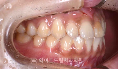 강남역앞니치과 / "신경치료한 치아가 누렇게 변했어요." 신경치료 후 변색된 치아, 어떻게 치료하나요? 관련 이미지 7