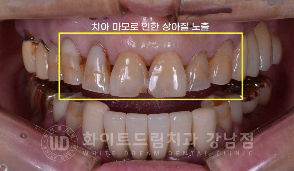 중년 앞니라미네이트 / 노화로 마모되고 누렇게 변한 치아, 어떻게 치료할까? 관련 이미지 8