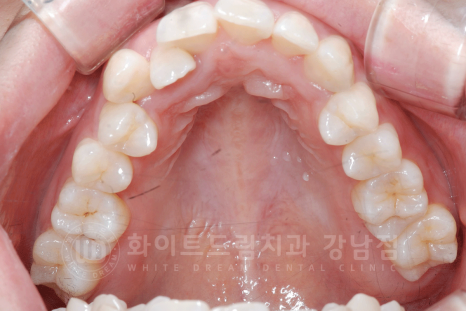 강남 덧니 비발치교정 / 임플란트와 치아교정 동시 진행 case 리뷰. 관련 이미지 20