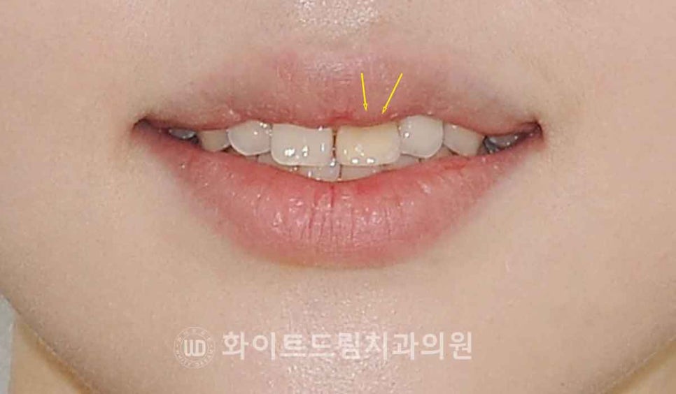 강남역앞니치과 / "신경치료한 치아가 누렇게 변했어요." 신경치료 후 변색된 치아, 어떻게 치료하나요? 관련 이미지 3