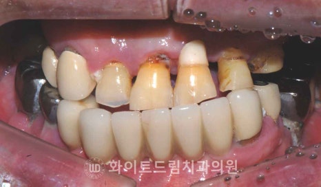 서울전체임플란트잘하는치과, 왜 치주염이 심해지면 반대교합까지 생길까요? (치주염 전체 임플란트 CASE) 관련 이미지 2