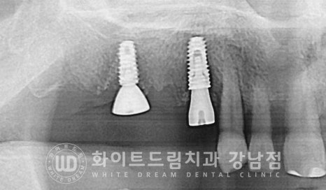 발치 즉시 임플란트 "내원 당일 발치 후 바로 임플란트 식립!" 관련 이미지 12