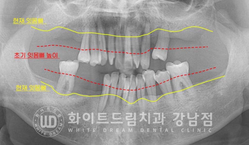 강남역 전악임플란트치과 / 치주 질환이 치아와 임플란트에 끼치는 영향! 관련 이미지 6