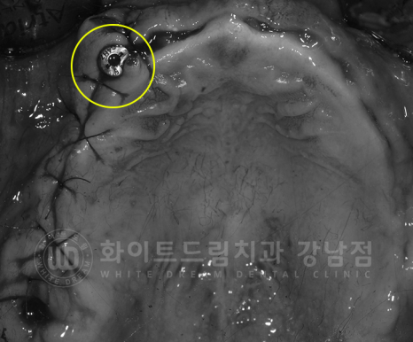 강남역 전체임플란트 치과 "치아가 심하게 흔들려요." 심한 치주염 임플란트 치료 관련 이미지 9