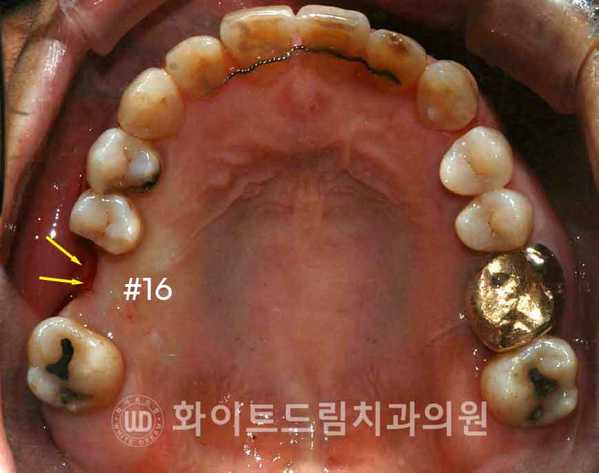 강남역어금니임플란트 치료 시 흔히 동반되는 상악동거상술 (Lateral window 방식), "잘 됐는지 어떻게 확인하죠?" 관련 이미지 6