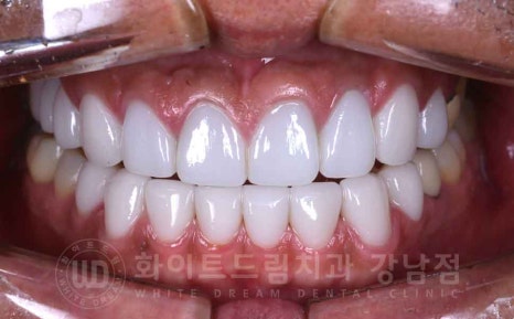역삼역 앞니 치료  "예전에 한 크라운, 라미네이트 바꾸고 싶어요" 라미네이트 & 크라운 재치료 관련 이미지 3