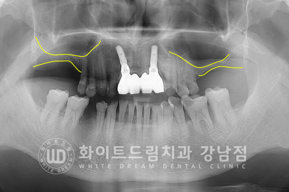 강남역 임플란트치과 / "어금니가 없고 이갈이가 심해요" 강남역 화이트드림치과 관련 이미지 3