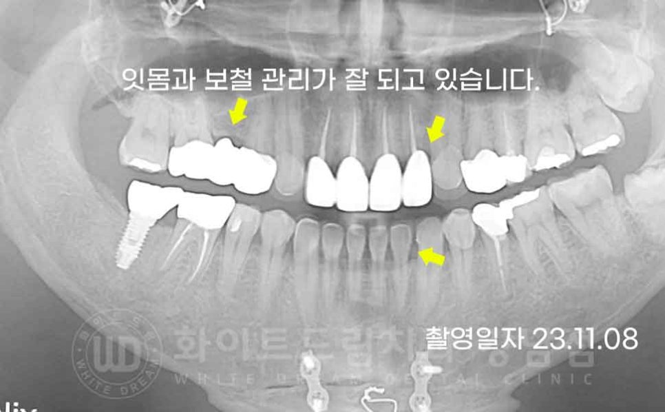 역삼역 앞니 치료  "예전에 한 크라운, 라미네이트 바꾸고 싶어요" 라미네이트 & 크라운 재치료 관련 이미지 11
