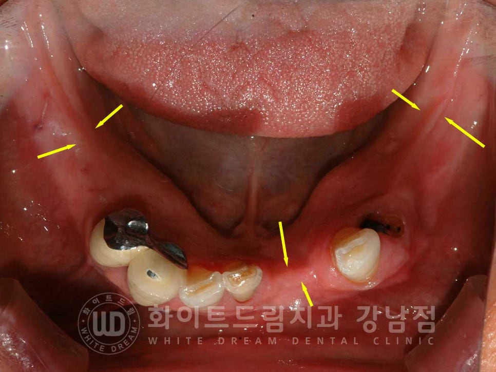 잇몸뼈가 없다는 게 무슨 말일까? "틀니를 오래 사용해서 잇몸뼈가 없대요" 임플란트 잘하는 강남치과 관련 이미지 5
