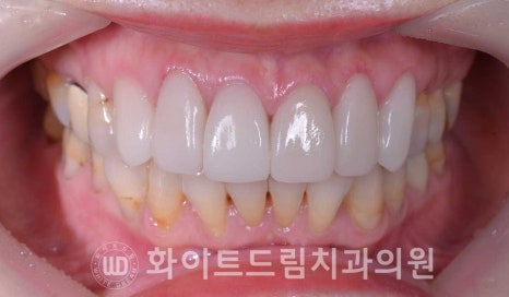 신논현라미네이트, 중년 충치치료, "치경부 우식증, 라미네이트로 당일 치료 OK" 관련 이미지 15