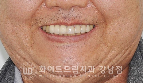 앞니 충치 라미네이트 치료 / "옆 크라운과 치아 색상을 맞추고 싶어요" 관련 이미지 12