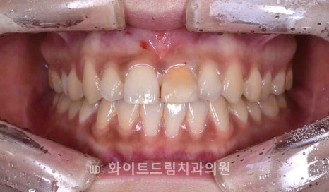 강남역앞니치과 / "신경치료한 치아가 누렇게 변했어요." 신경치료 후 변색된 치아, 어떻게 치료하나요? 관련 이미지 15