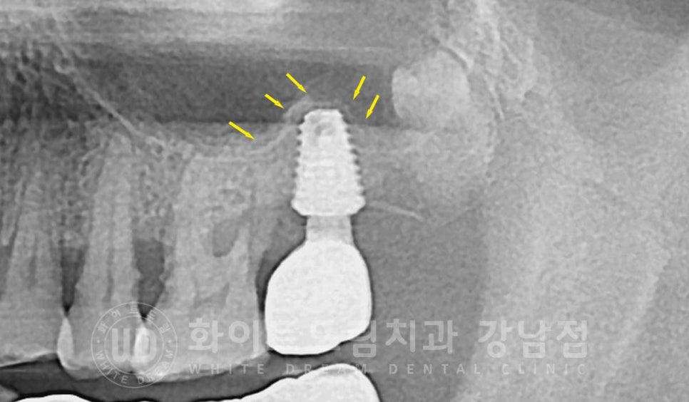 [흔들리는 어금니크라운] 흔들리고 냄새나는 오래된 크라운, 원인은? 관련 이미지 11