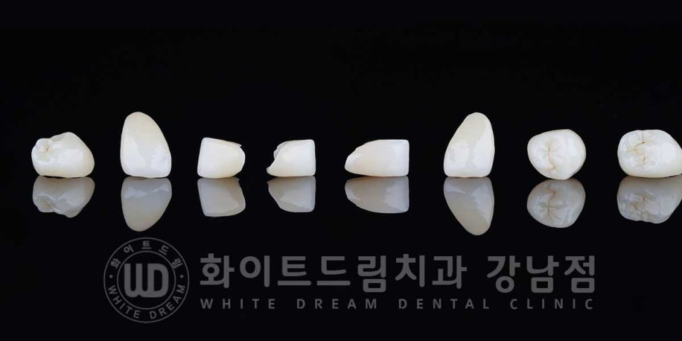 역삼역 왜소치치료 / 치아 하나가 너무 작아요. 왜소치 라미네이트 잘하는 치과 관련 이미지 8