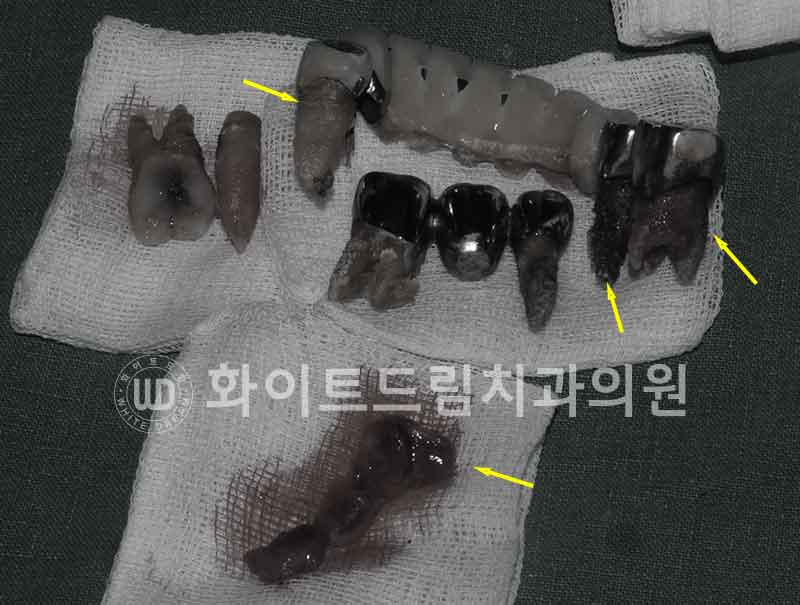 서울전체임플란트잘하는치과, 왜 치주염이 심해지면 반대교합까지 생길까요? (치주염 전체 임플란트 CASE) 관련 이미지 13